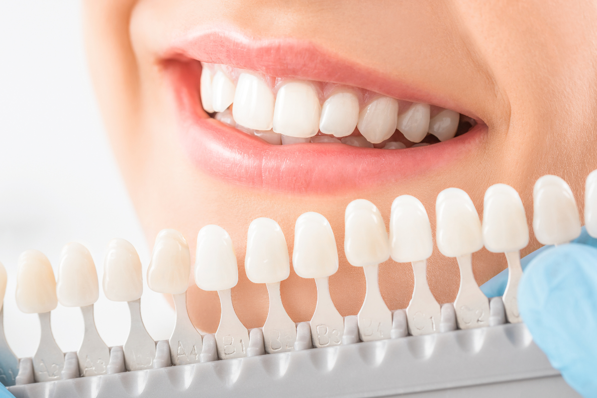 Whiten Your Teeth at Home, The Right Way!
